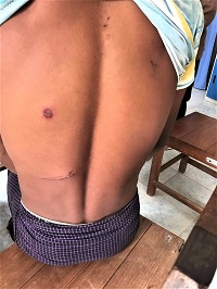 Injured back of Christian in Paw Lwe village, central Burma attacked on Dec. 17, 2018. / Morning Star News